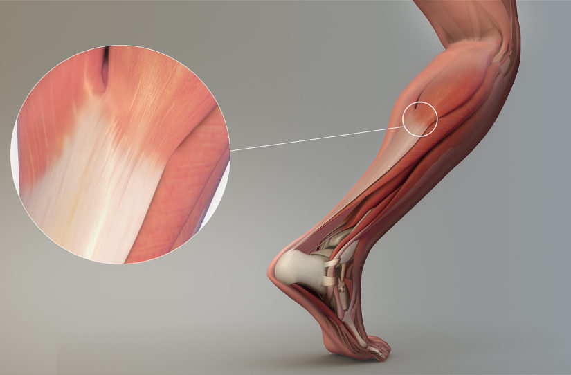 Ondas de choque para tendão calcificado