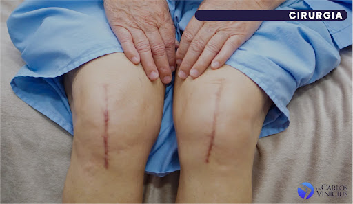 artroplastia total do joelho