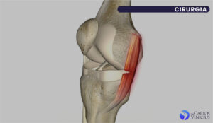 ligamento colateral medial