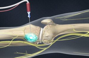 neurotomia-para-tratar-artrose-do-joelho