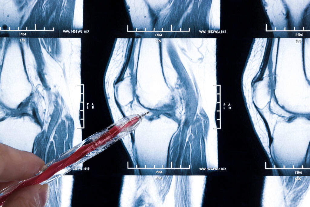 Ressonância magnética destacando uma ruptura horizontal do menisco com uma caneta indicando a área específica, relevante para discussões sobre opções de tratamento.