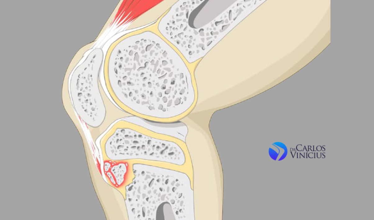 osgood-schlatter