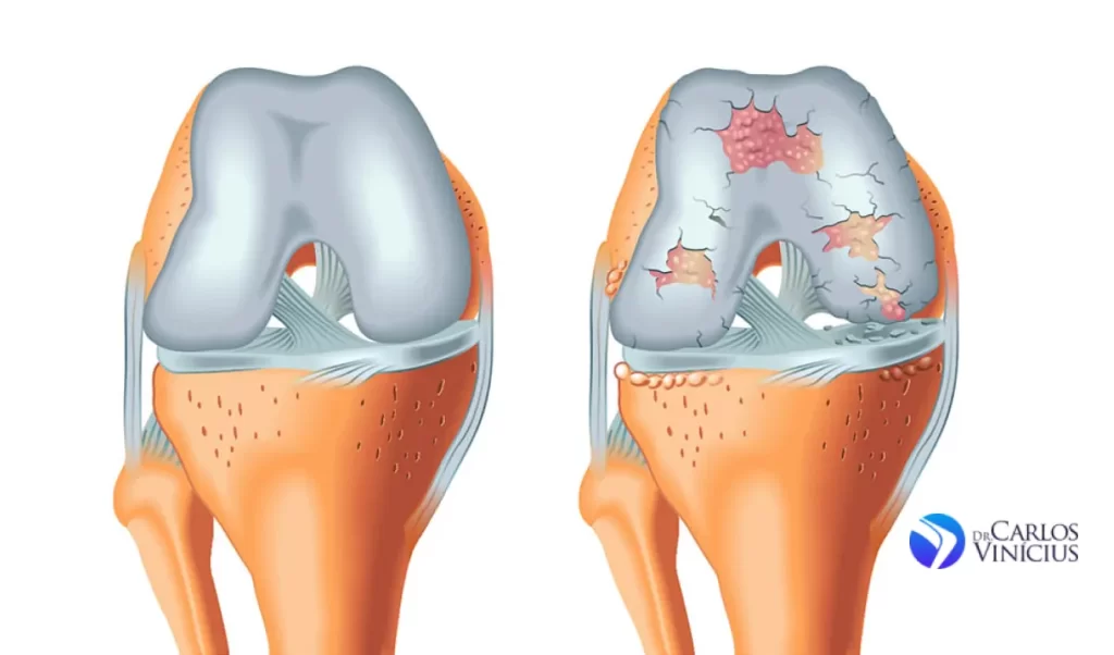 artrose-no-joelho