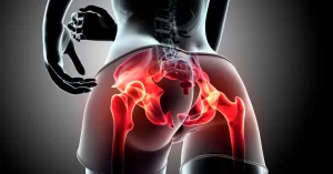 tendinites-do-quadril