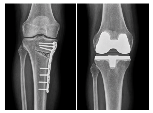 osteotomia e protese