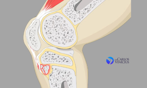 osgood-schlatter