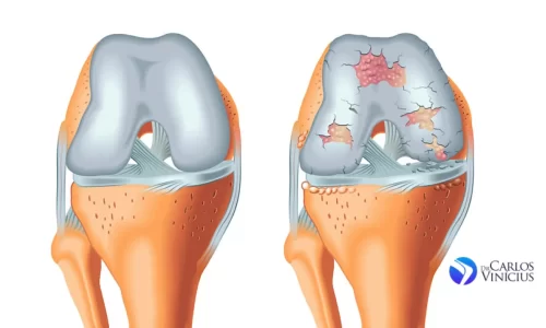 artrose-no-joelho