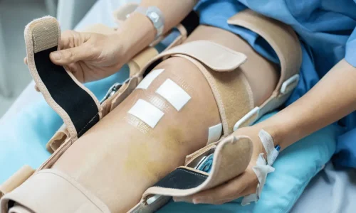 cirurgia-de-lca-e-tranquila