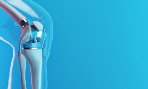 Ilustração digital de uma prótese de joelho implantada, mostrando uma visão lateral do joelho com componentes metálicos e plásticos substituindo as superfícies articulares naturais.