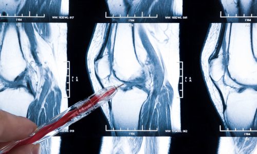 Ressonância magnética destacando uma ruptura horizontal do menisco com uma caneta indicando a área específica, relevante para discussões sobre opções de tratamento.