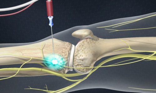 neurotomia-para-tratar-artrose-do-joelho
