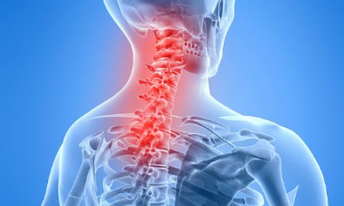dor cervical