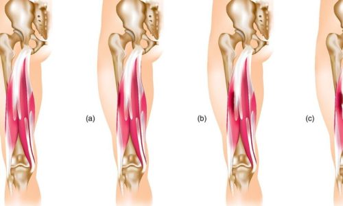 lesão muscular