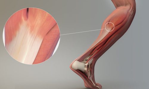 Ondas de choque para tendão calcificado
