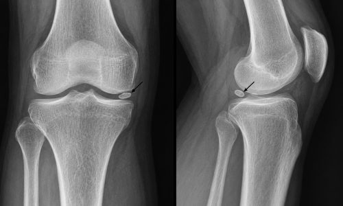 ossiculo-meniscal