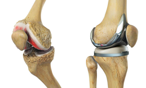quando-fazer-cirurgia-protese-joelho