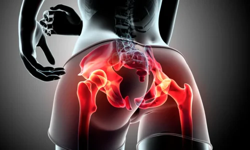 tendinites-do-quadril